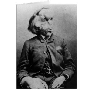 Joseph "John" Merrick The Elephant Man from 1889