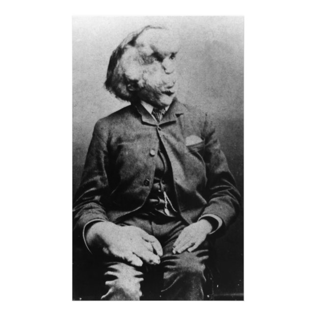 Joseph "John" Merrick The Elephant Man from 1889 Photo Print (Front)