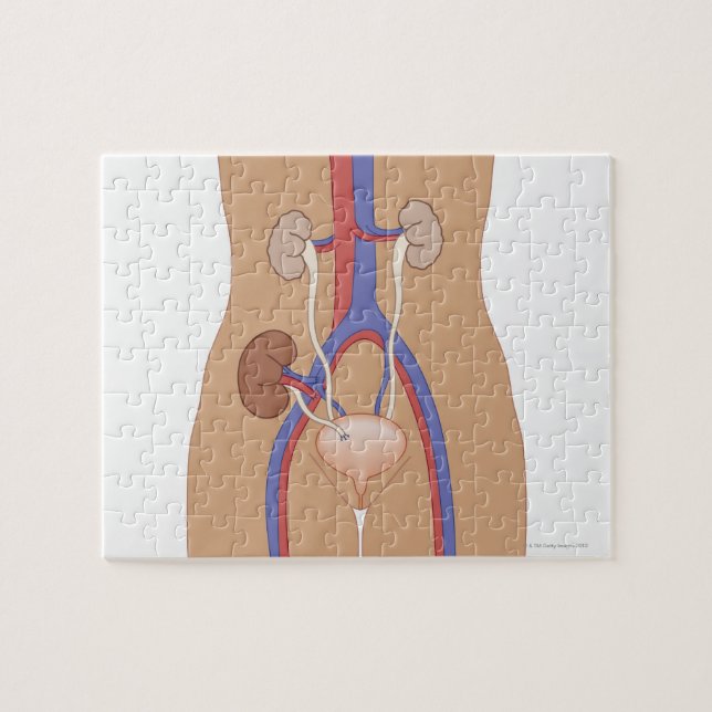 Kidney Transplant Jigsaw Puzzle (Horizontal)