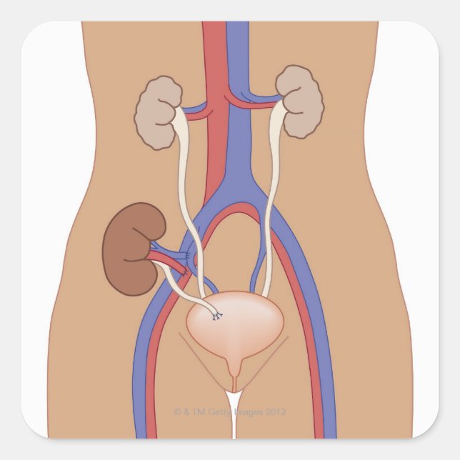 Kidney Transplant Square Sticker (Front)