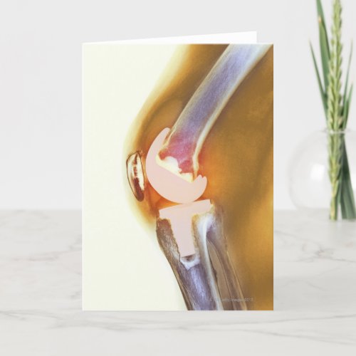Knee replacement Colored X_ray of a total knee Card