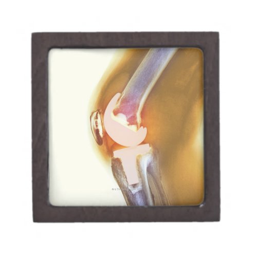 Knee replacement Coloured X_ray of a total knee Jewelry Box