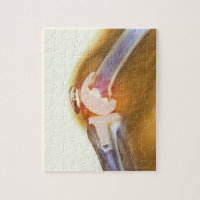 Knee replacement. Coloured X-ray of a total knee