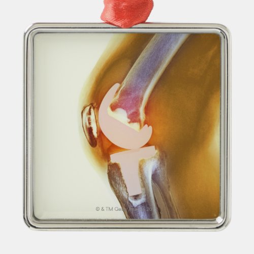 Knee replacement Coloured X_ray of a total knee Metal Ornament