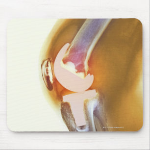 Knee replacement. Coloured X-ray of a total knee Mouse Pad