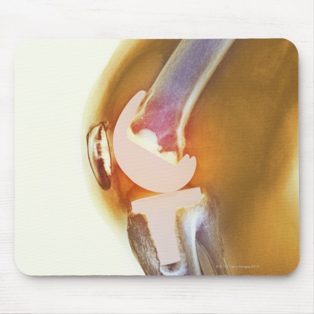 Knee replacement. Coloured X-ray of a total knee Mouse Pad (Front)