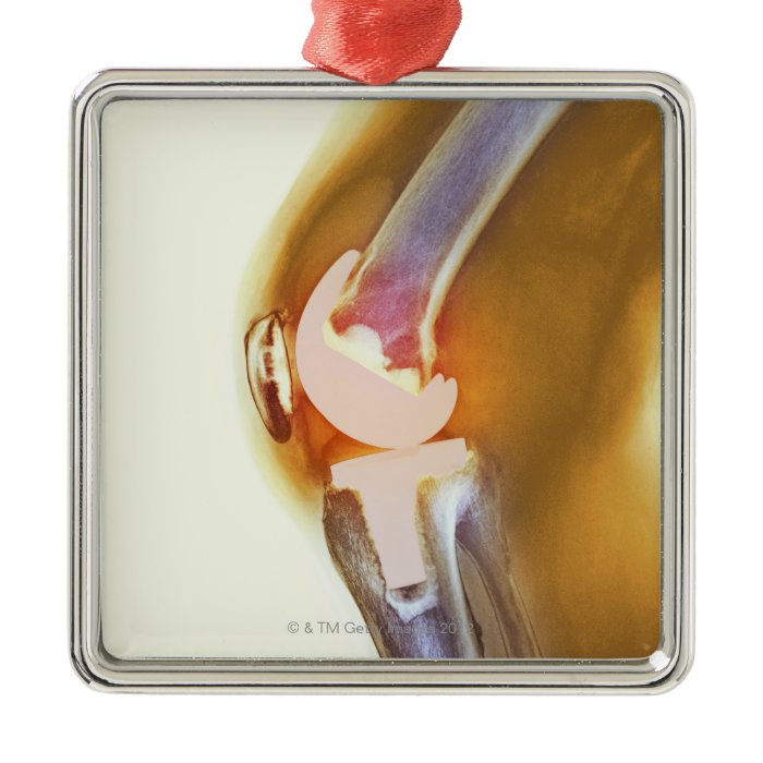 Knee replacement. Coloured X ray of a total knee Christmas Tree Ornaments