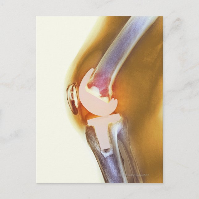 Knee replacement. Coloured X-ray of a total knee Postcard (Front)