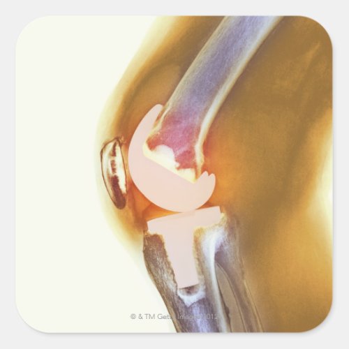 Knee replacement Coloured X_ray of a total knee Square Sticker