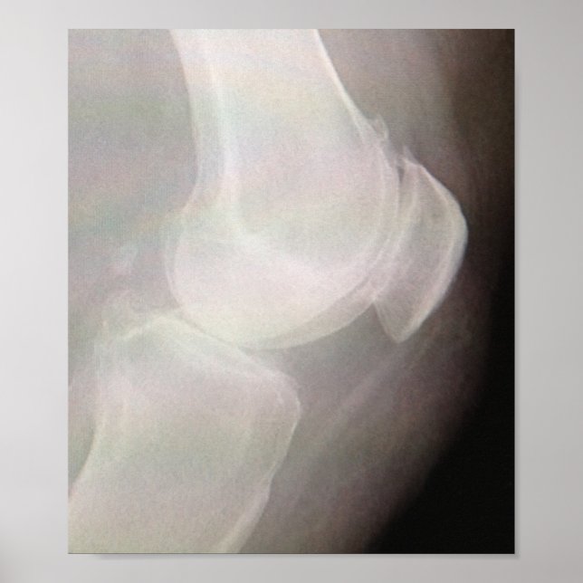 Knee X-ray Poster (Front)