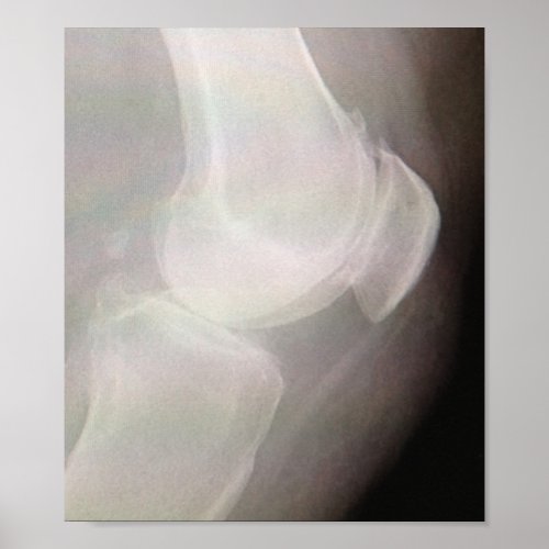 Knee X_ray Poster