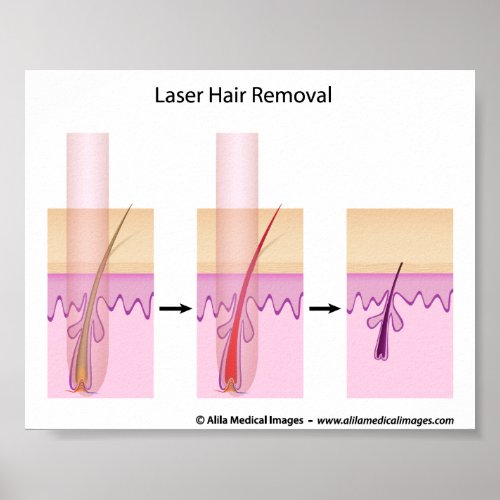 Laser hair removal procedure poster
