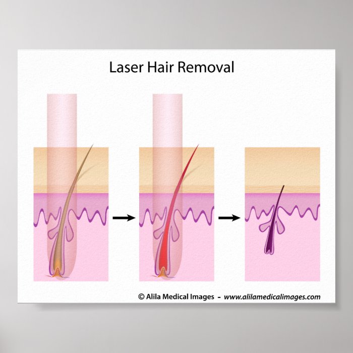 Laser hair removal procedure posters