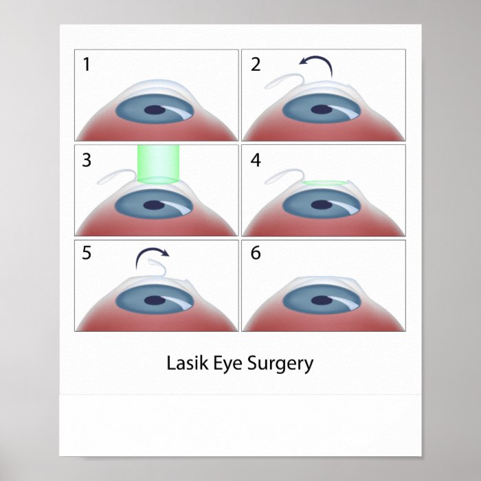 Lasik eye surgery procedure Poster