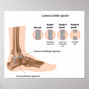 Lateral ankle sprains grading Poster