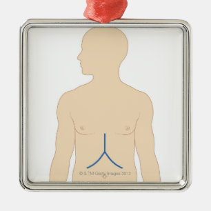Liver Transplant Metal Ornament
