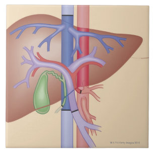 Liver Transplant Procedure Ceramic Tile