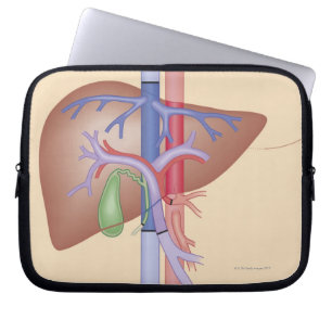 Liver Transplant Procedure Laptop Sleeve