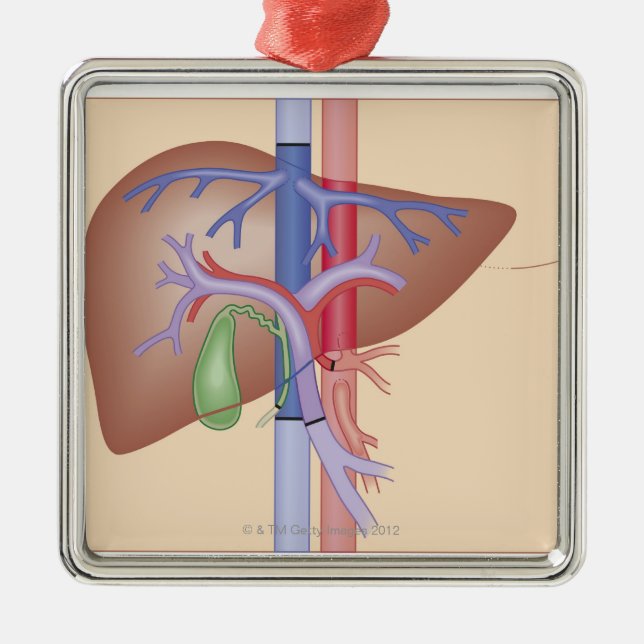 Liver Transplant Procedure Metal Ornament (Front)