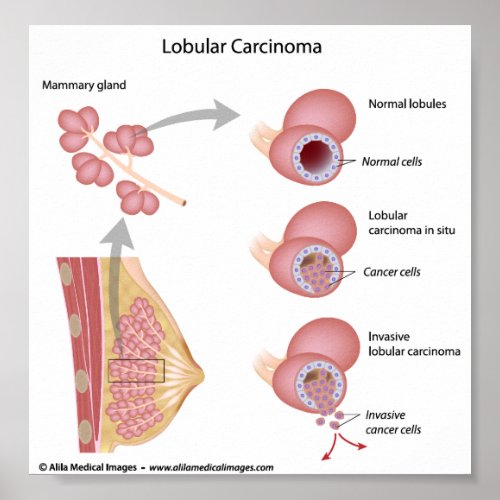Lobular breast cancer labeled diagram poster