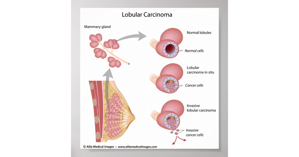 lobular breast cancer labeled diagram poster zazzle com face diagram with labels