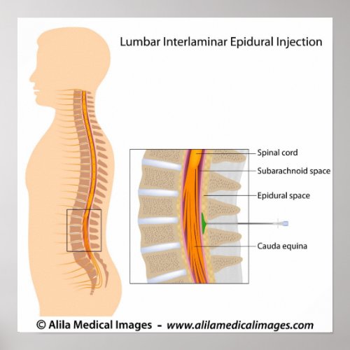 Lumbar epidural injection labeled diagram poster