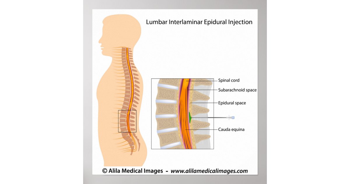 class iphone diagram poster injection, epidural labeled diagram. Lumbar