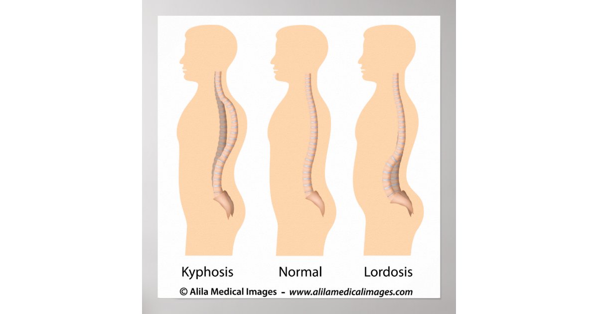 Lumbar lordosis and kyphosis, medical drawing. poster