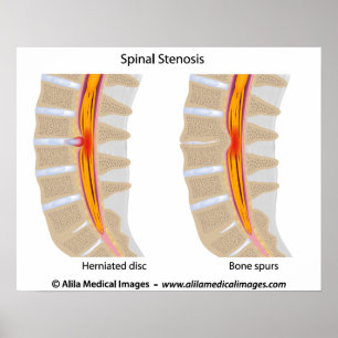 Lumbar Spinal Stenosis, medical drawing. Poster