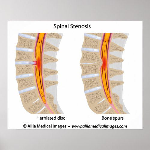 Lumbar Spinal Stenosis medical drawing Poster