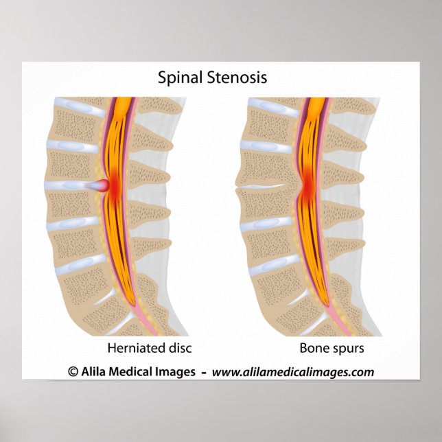 Lumbar Spinal Stenosis, medical drawing. Poster (Front)