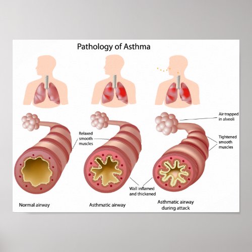 Lung disease Asthma Poster