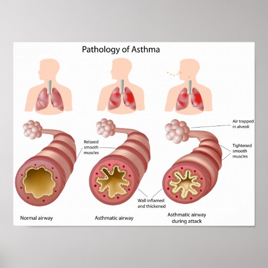 Lung disease Asthma Poster | Zazzle.com