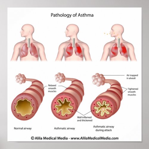 Lung disease Asthma Poster