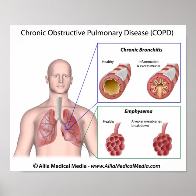 Lung disease COPD labeled Poster (Front)