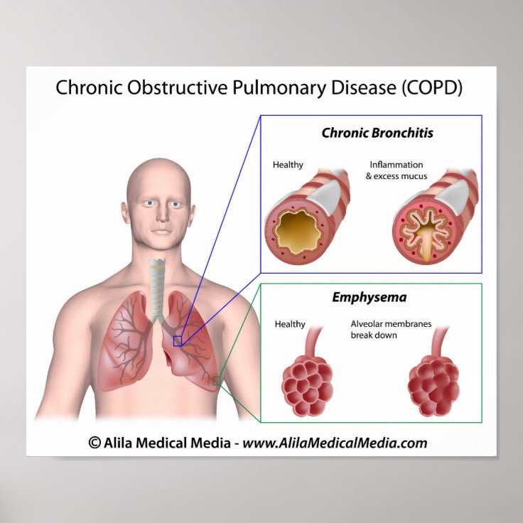 Lung disease COPD labeled Poster | Zazzle