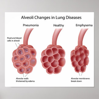 Pulmonary Posters | Zazzle