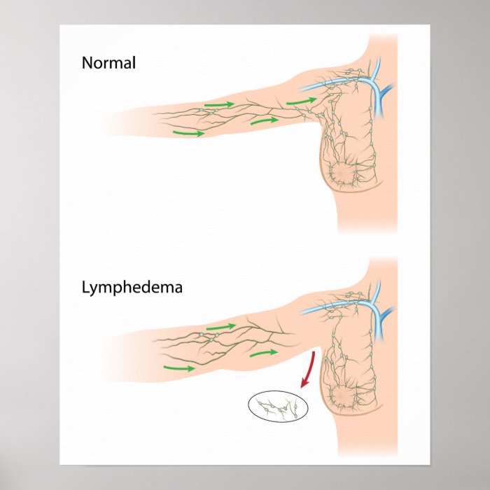 lymphedema arm disease diagram poster