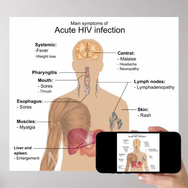 Main Symptoms Of Acute Hiv Infection Poster Zazzle