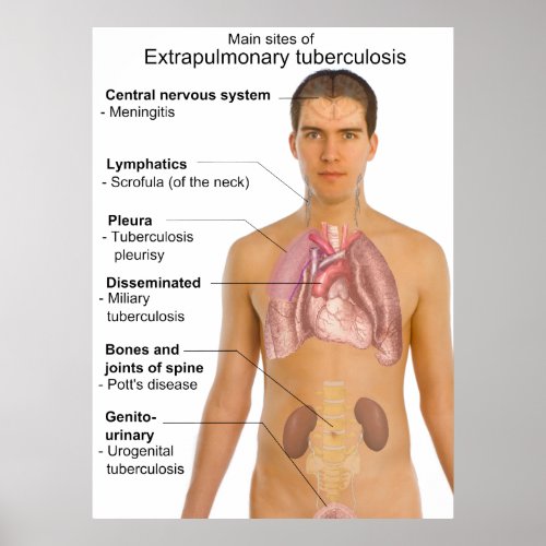 Main Symptoms of Extrapulmonary Tuberculosis Chart