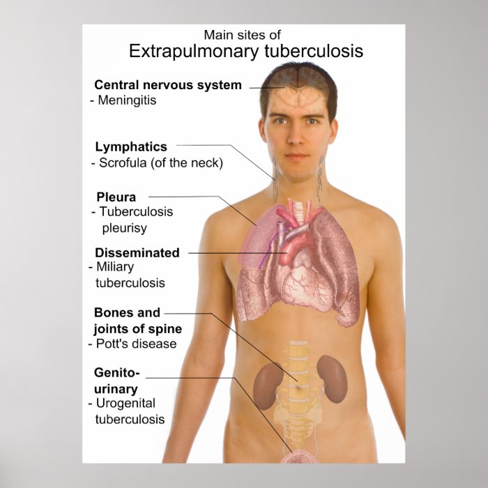 Main Symptoms of Extrapulmonary Tuberculosis Chart Posters