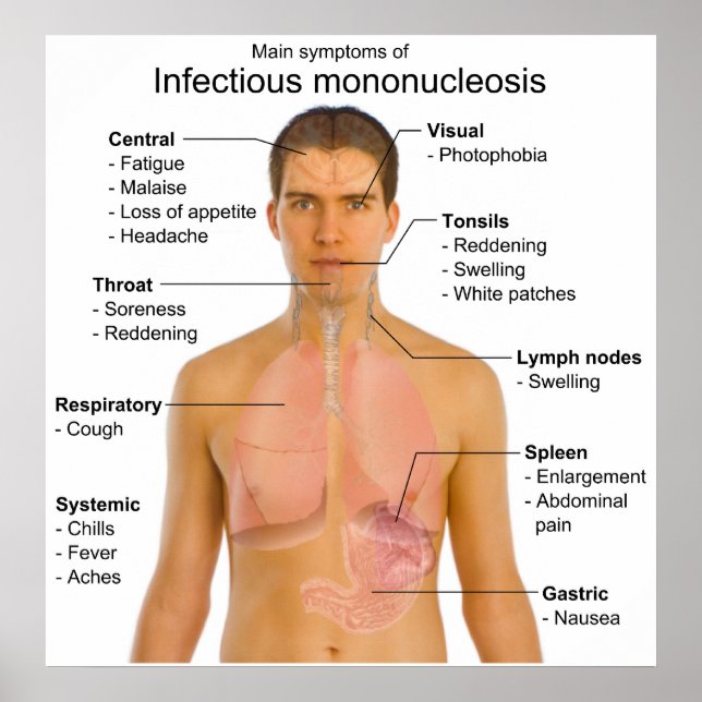 Main Symptoms of Infectious Mononucleosis Chart (Front)