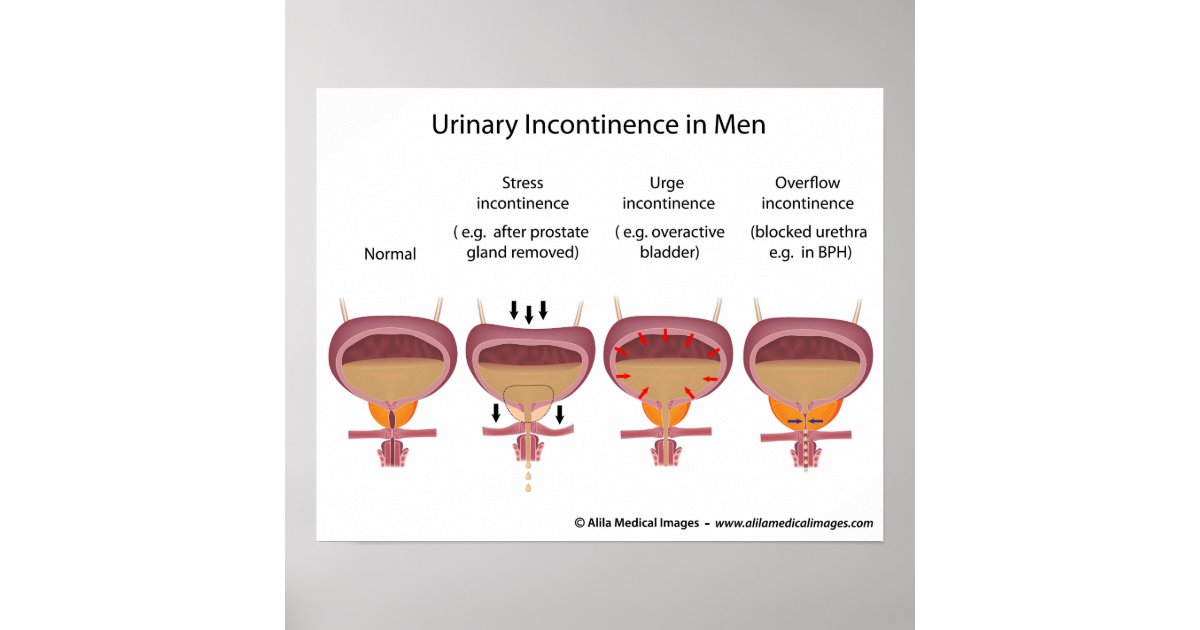 Male urinary incontinence poster | Zazzle