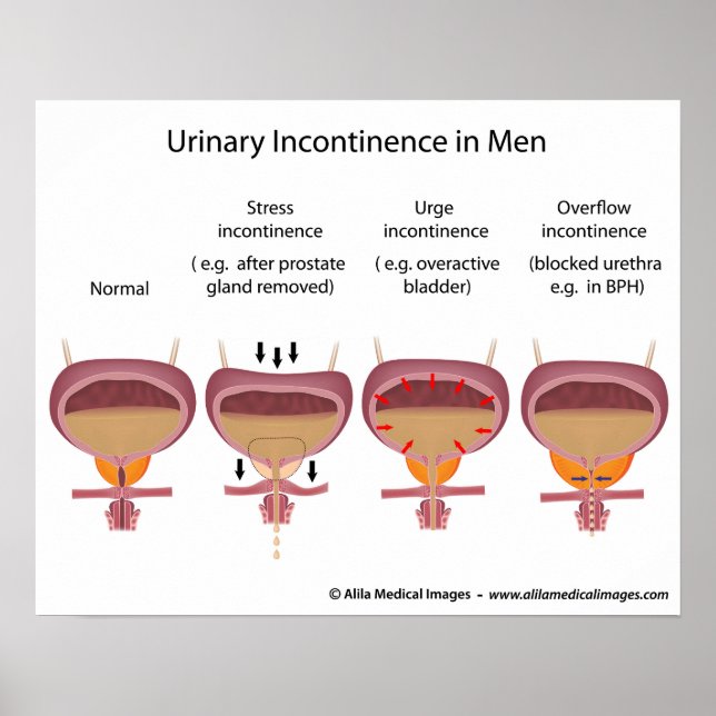 Male urinary incontinence poster (Front)