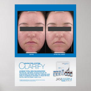 Marini Peel Clarify Results 18x24" Poster