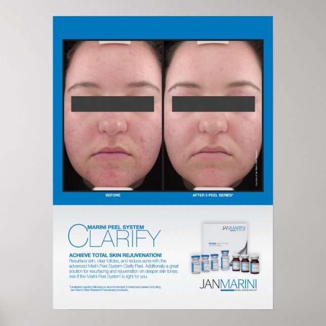 Marini Peel Clarify Results 18x24" Poster (Front)