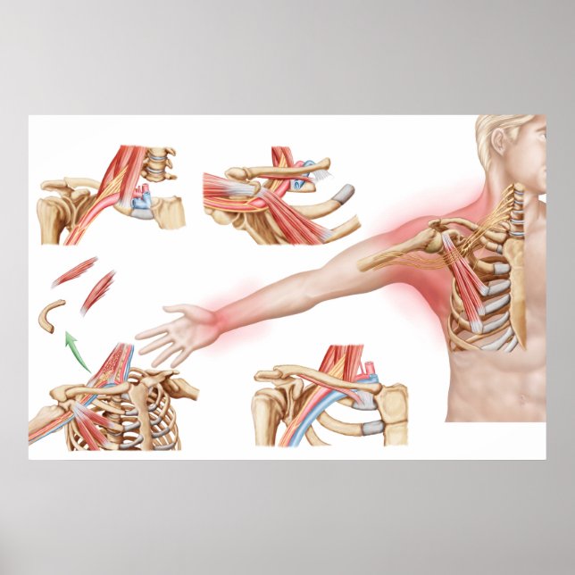 Medical Illustration Detailing Thoracic Outlet Poster (Front)