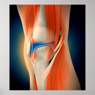 Medical Illustration: Inflammation In Knee Poster
