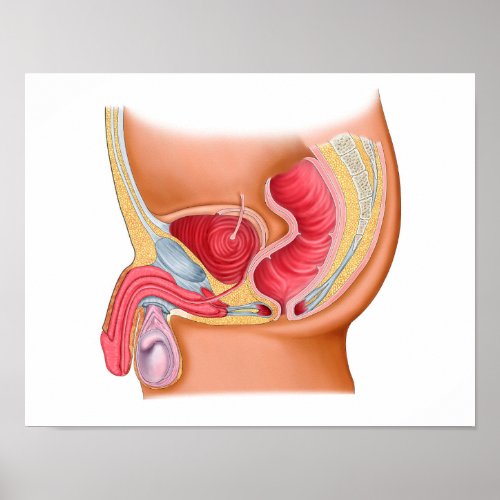 Medical Illustration Of A Rectourethral Fistula Poster