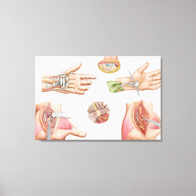 Medical Illustration Showing Carpal Tunnel Canvas Print (Front)